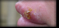 Herpes Simplex