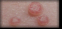 Molusco Contagioso